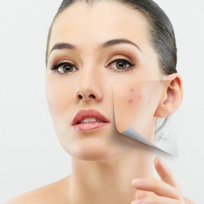 acne-scars-img-400x375